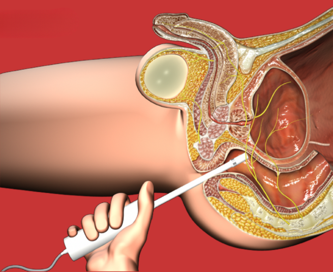 Transrectal ultrasound scan